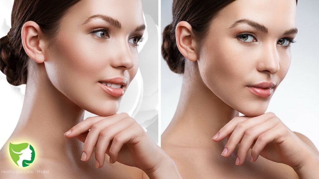 botox3