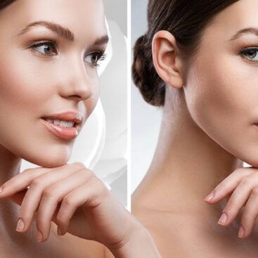 botox3