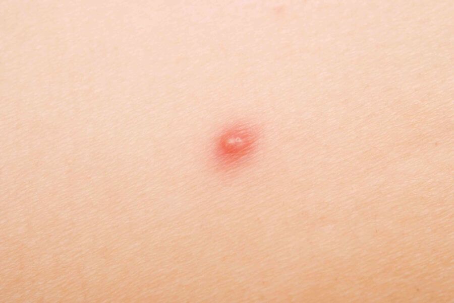 6 Reasons Why Not to Pop that Pimple
