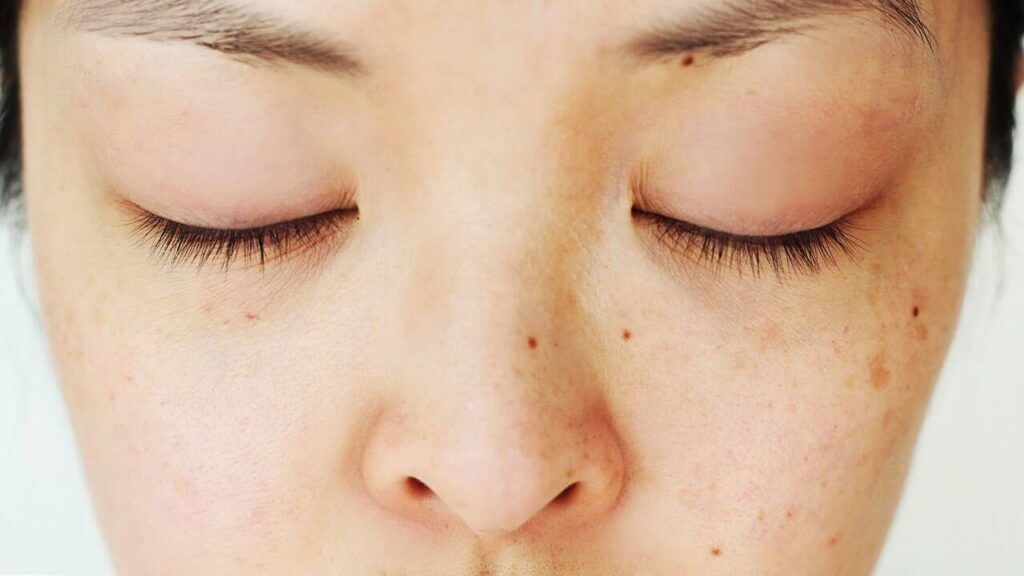 Skin Spot Guide Skin Spots: Age Spots, Moles, Melasma, and Freckles Differences