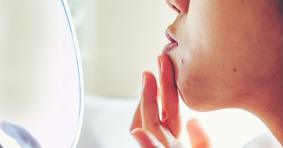 dairy consumption might cause acne