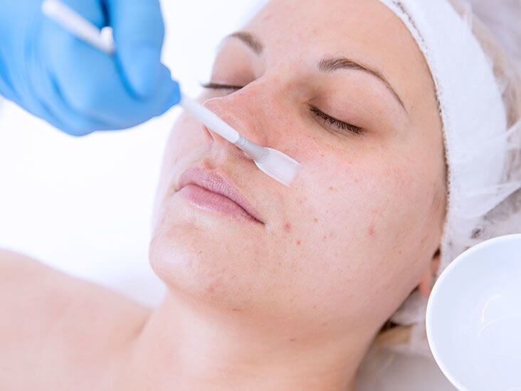 chemical peels to prevent age spots