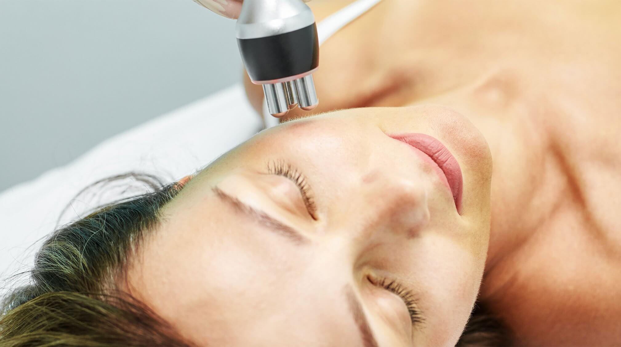 laser treatment to prevent age spots