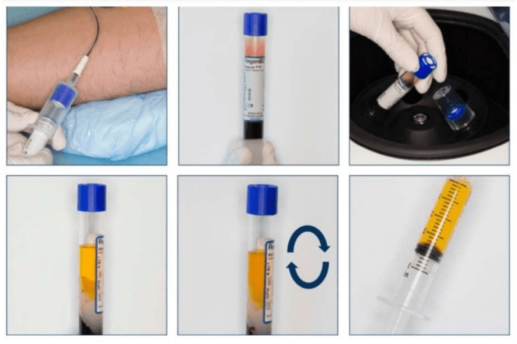 How to use PRP