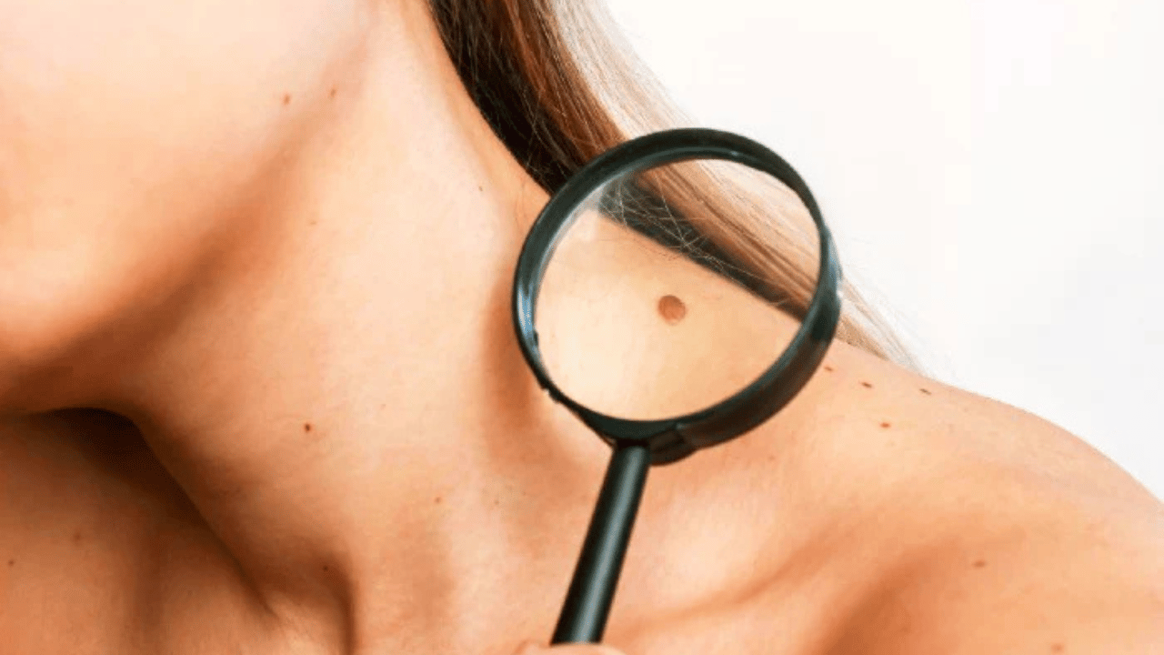 Laser Mole Removal: The Cutting-Edge Technology Transforming Skin 