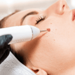 Laser Mole Removal: The Cutting-Edge Technology Transforming Skin Laser Mole Removal: The Cutting-Edge Technology Transforming Skin