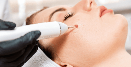Laser Mole Removal: The Cutting-Edge Technology Transforming Skin