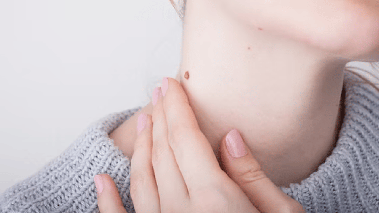 Laser Mole Removal: The Cutting-Edge Technology Transforming Skin 