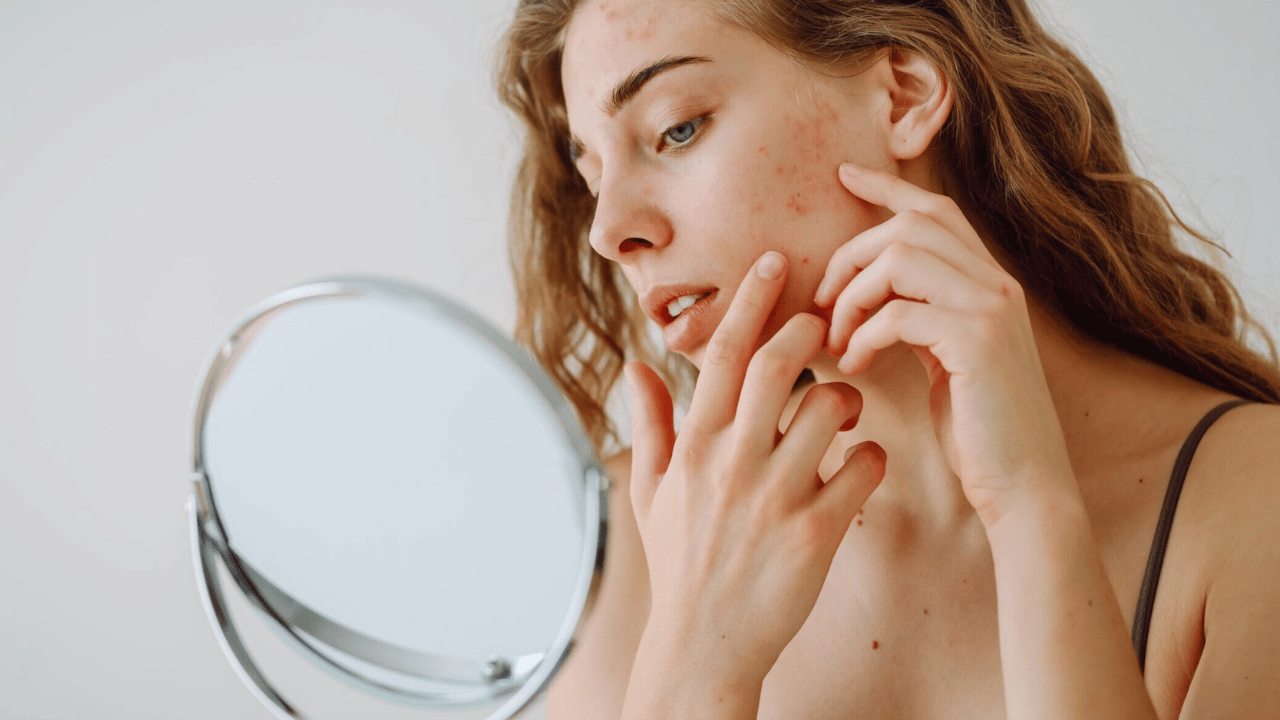 Transform Your Skin Effective Acne Solutions Revealed (1)
