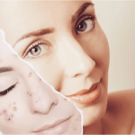 Transform Your Skin: Effective Acne Solutions Revealed Transform Your Skin Effective Acne Solutions Revealed