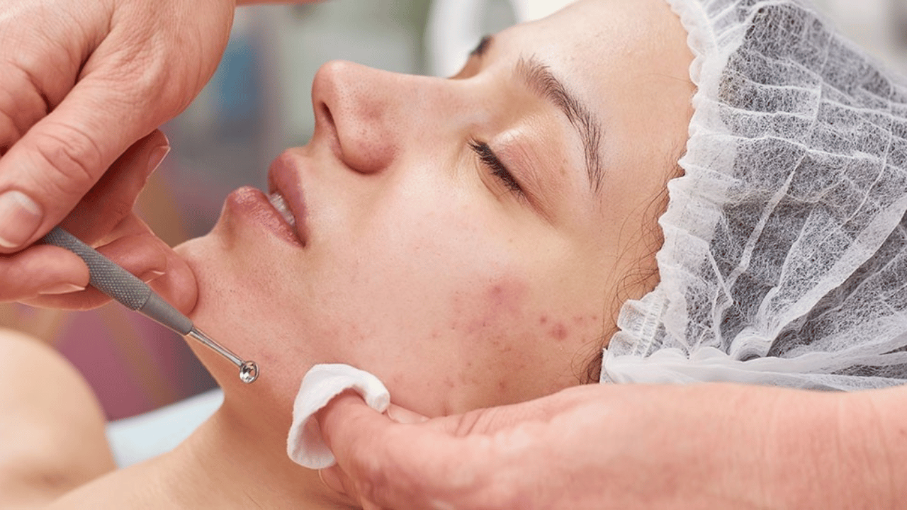 Transform Your Skin Effective Acne Solutions Revealed (4)