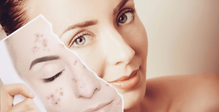 Transform Your Skin Effective Acne Solutions Revealed