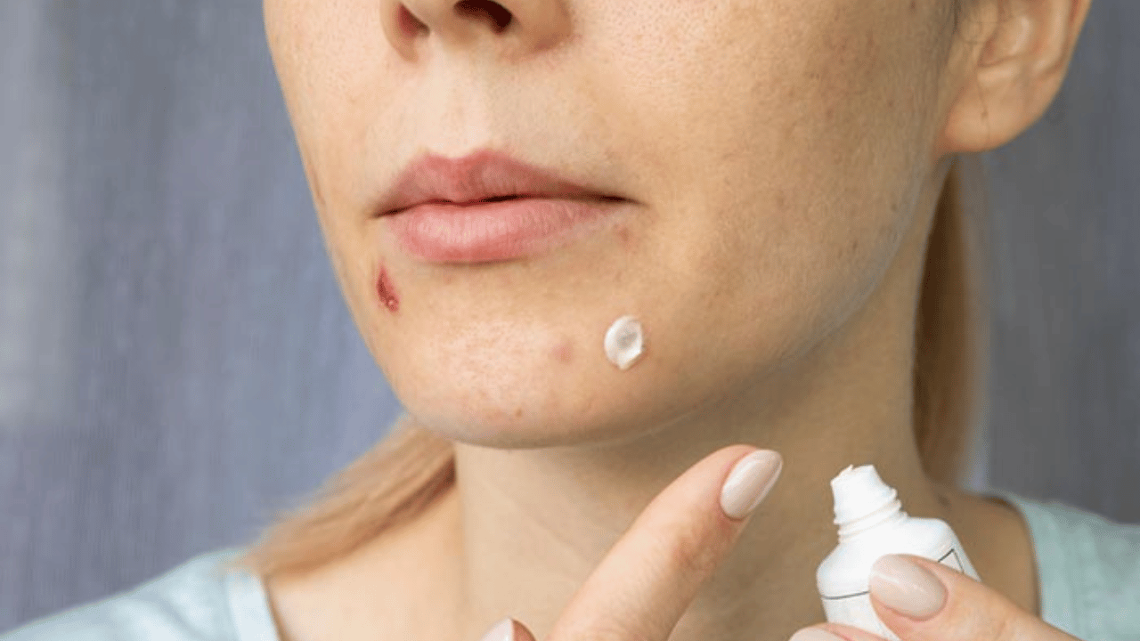 Transform Your Skin Effective Acne Solutions Revealed (6)