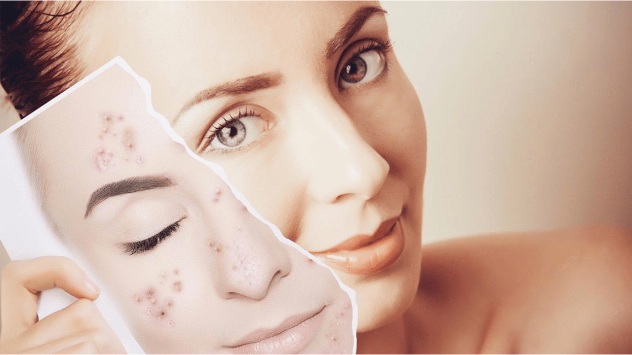 Transform Your Skin Effective Acne Solutions Revealed